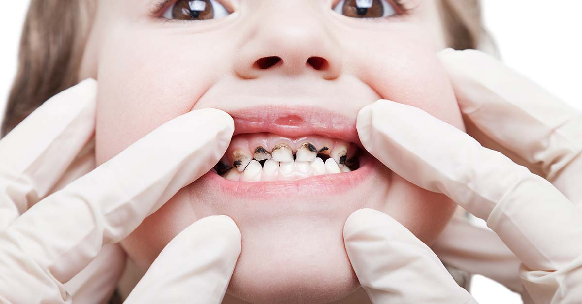 Caries???
